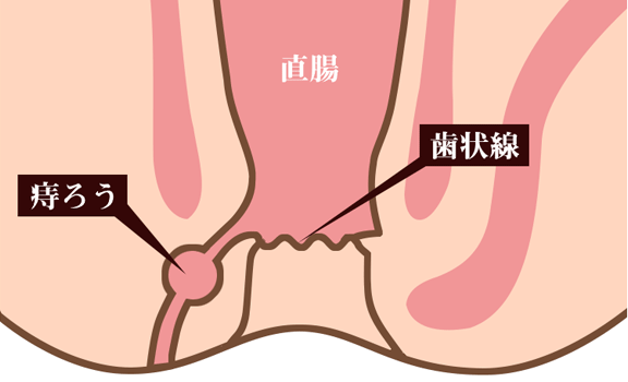 肛門 周囲 膿瘍