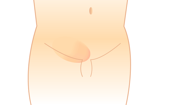 脱腸・鼠径ヘルニアの断面図（イラスト）