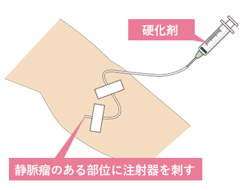 varicose-veins-treatment02m