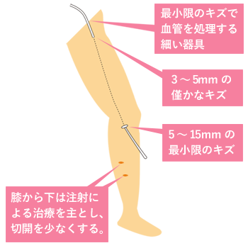 varicose-veins-treatment03m