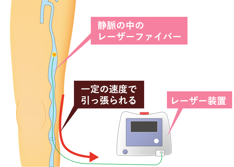 varicose-veins-treatment12