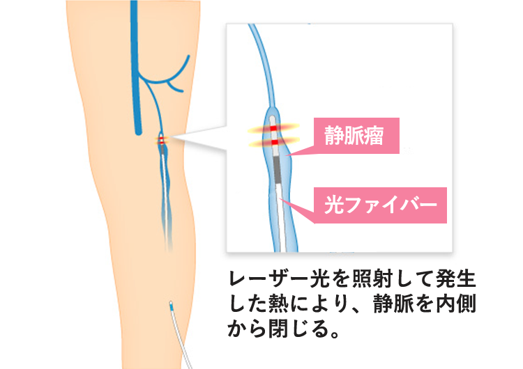 varicose-veins-treatment13