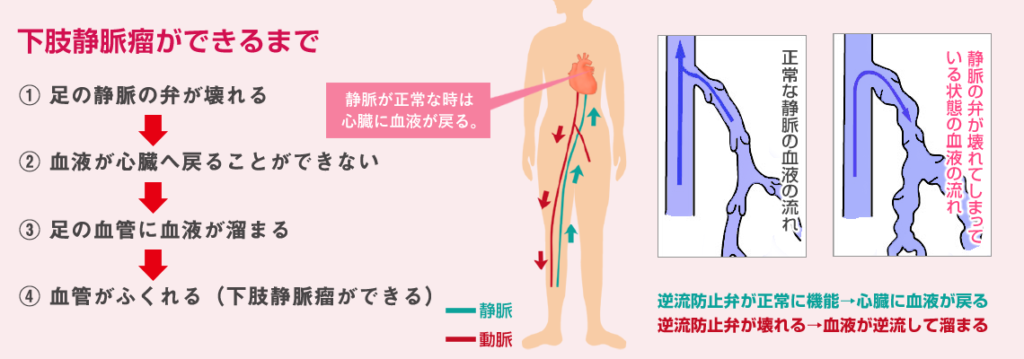 varicose-veins06m