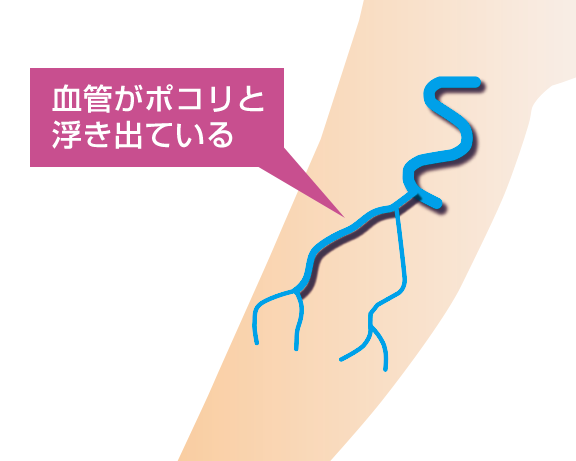 varicose-veins13m*