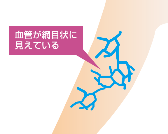 varicose-veins14m*