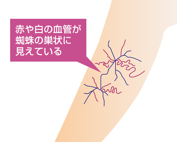varicose-veins15m*
