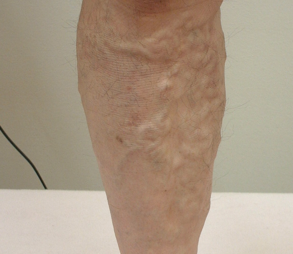 varicose-veins16m