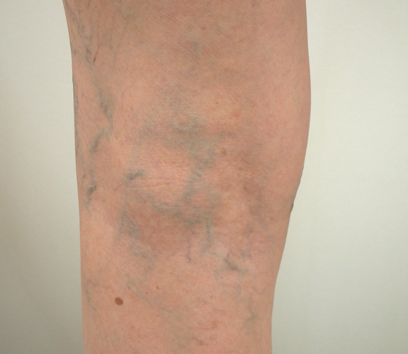 varicose-veins17m