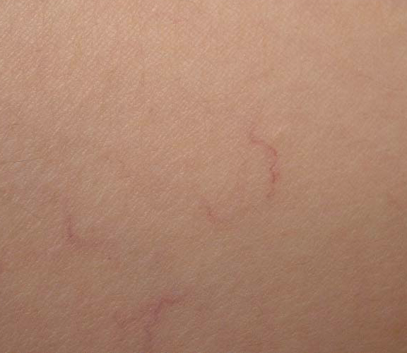 varicose-veins18m