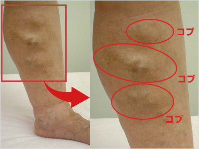 varicose-veins19m