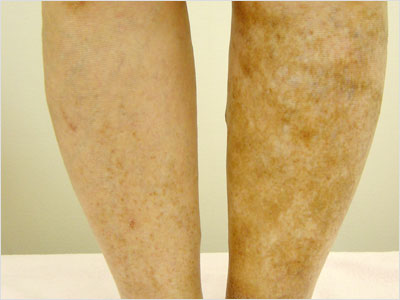 varicose-veins20m