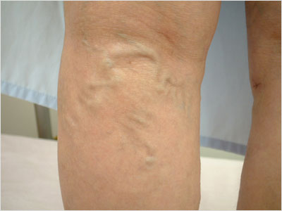 varicose-veins21m