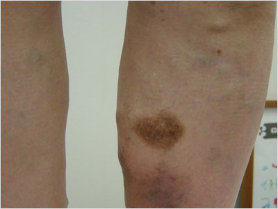 varicose-veins22m