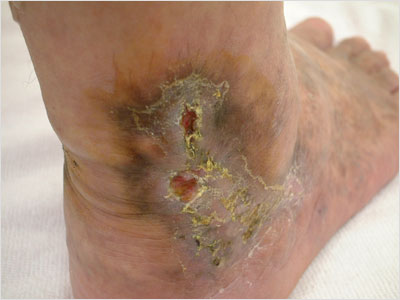 varicose-veins23m