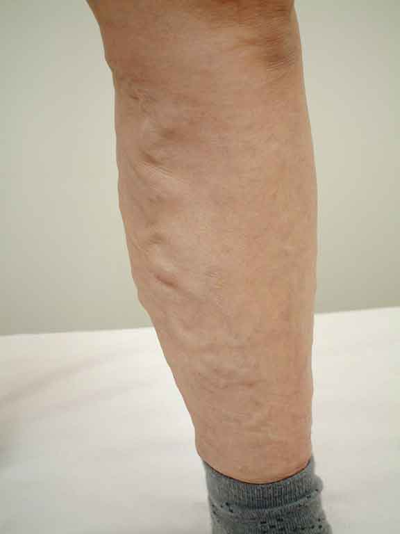 varicose-veins27a