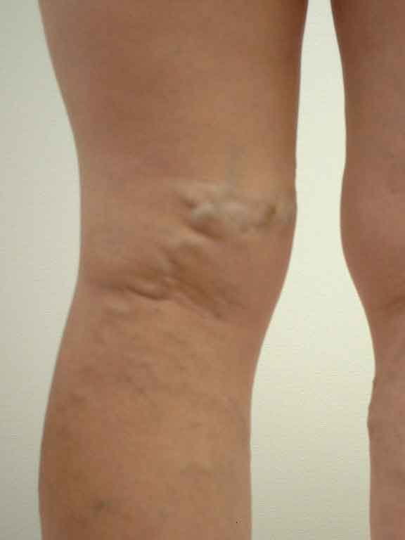 varicose-veins27b