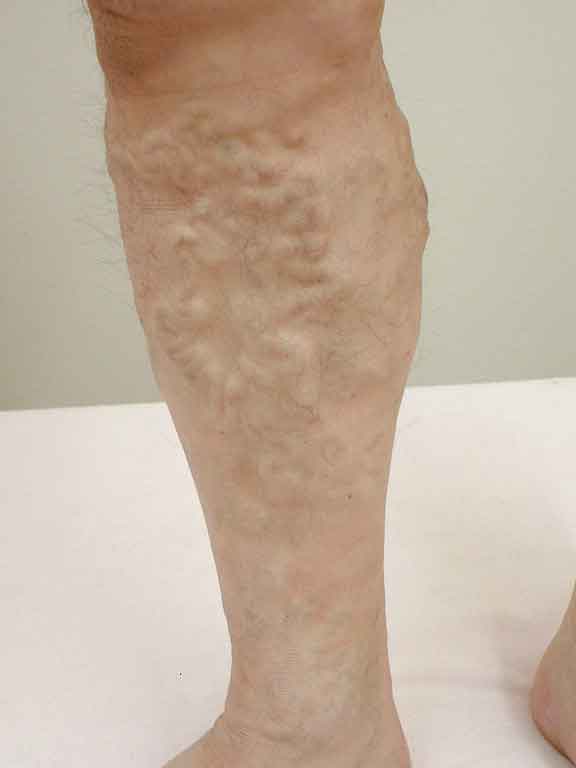 varicose-veins27c