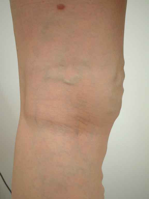 varicose-veins27d