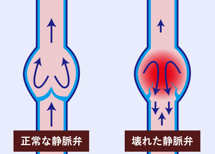 varicose-veins29